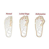 Bunion Corrector Brace - Splint Wrap  ~ Big Toe Straightener - Brace Professionals -