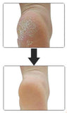 Heel Spur Relief -  Massage Gel Cup Pads for Plantar Fasciitis - Brace Professionals -